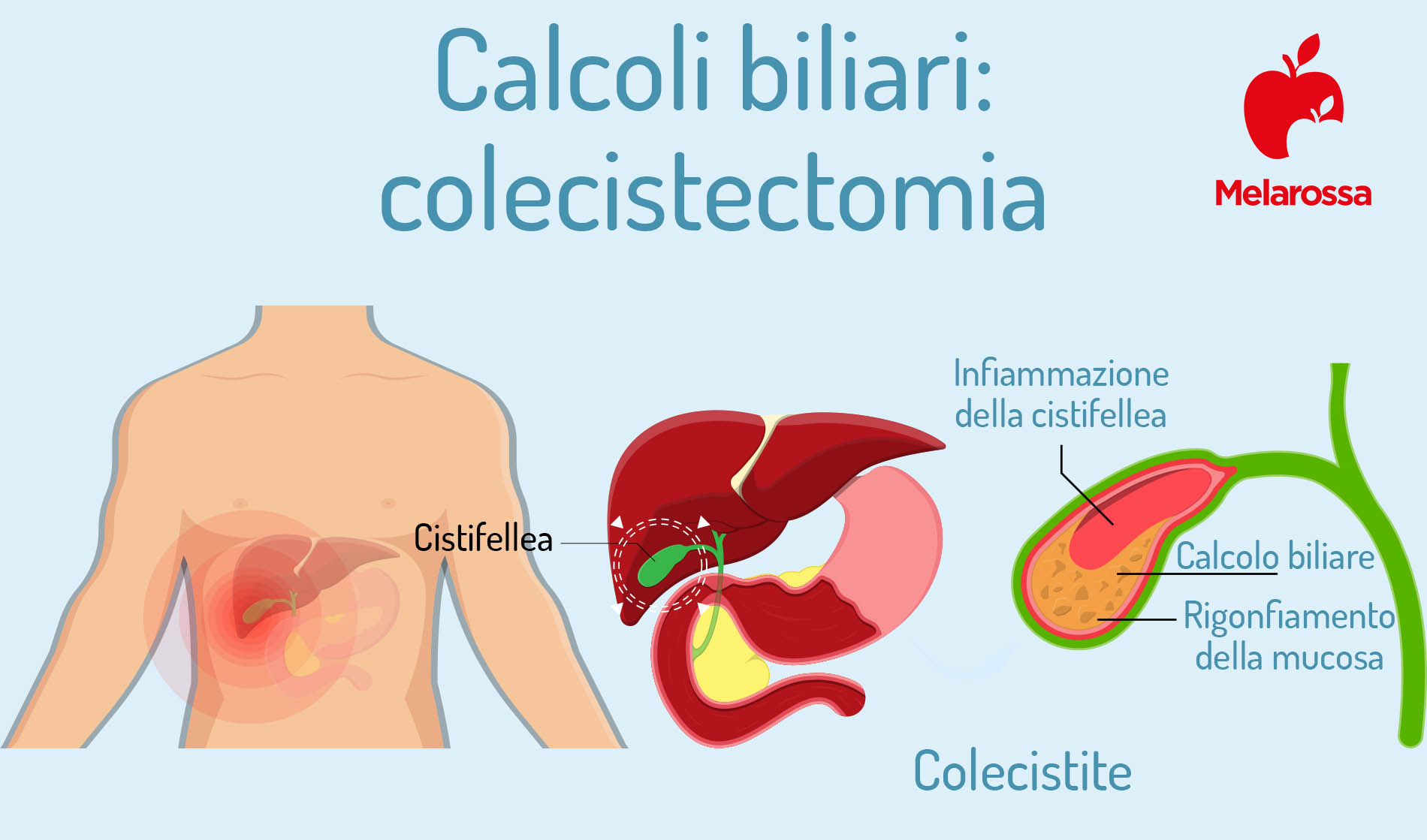 calcoli biliari: colecistectomia