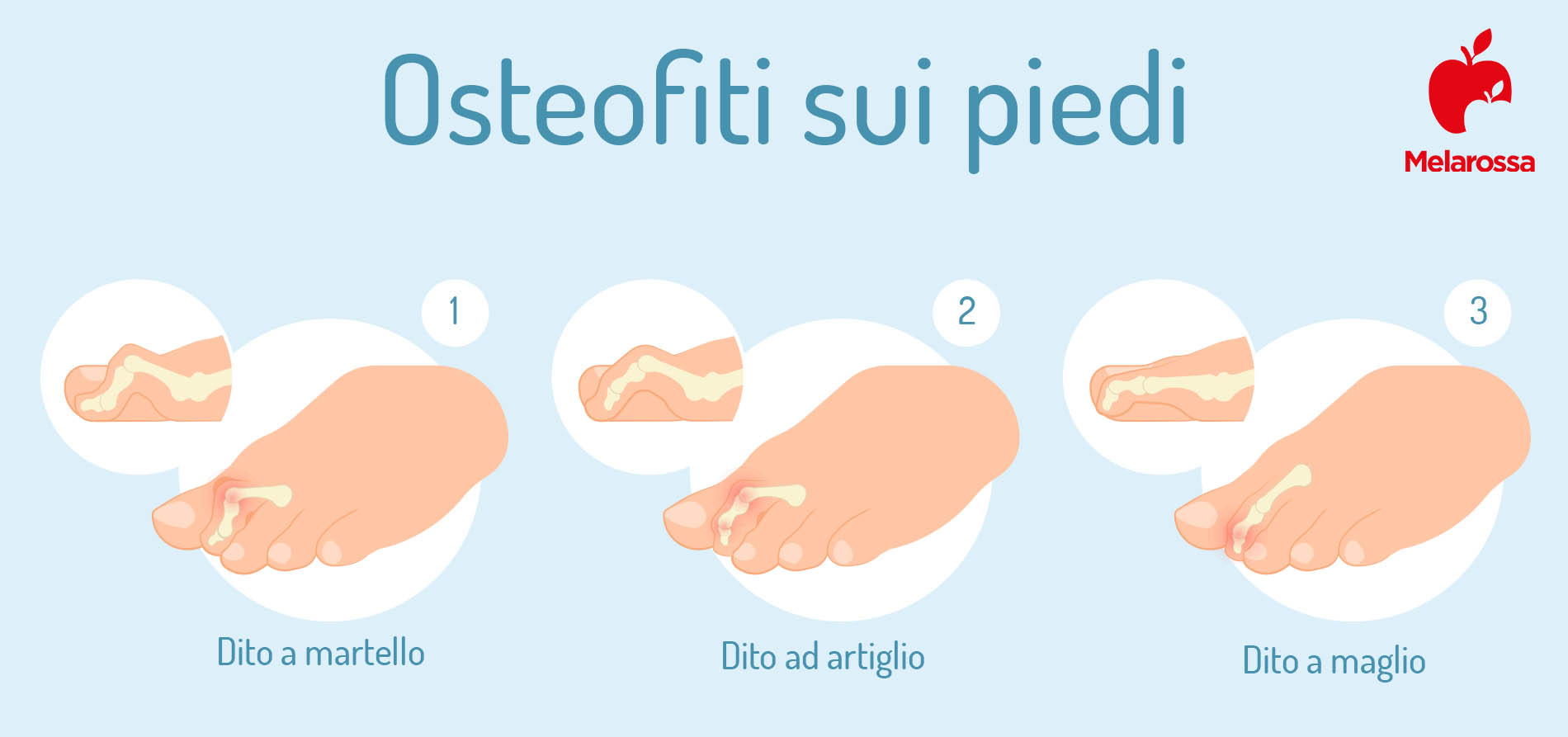 osteofitosi: osteofiti  piedi 