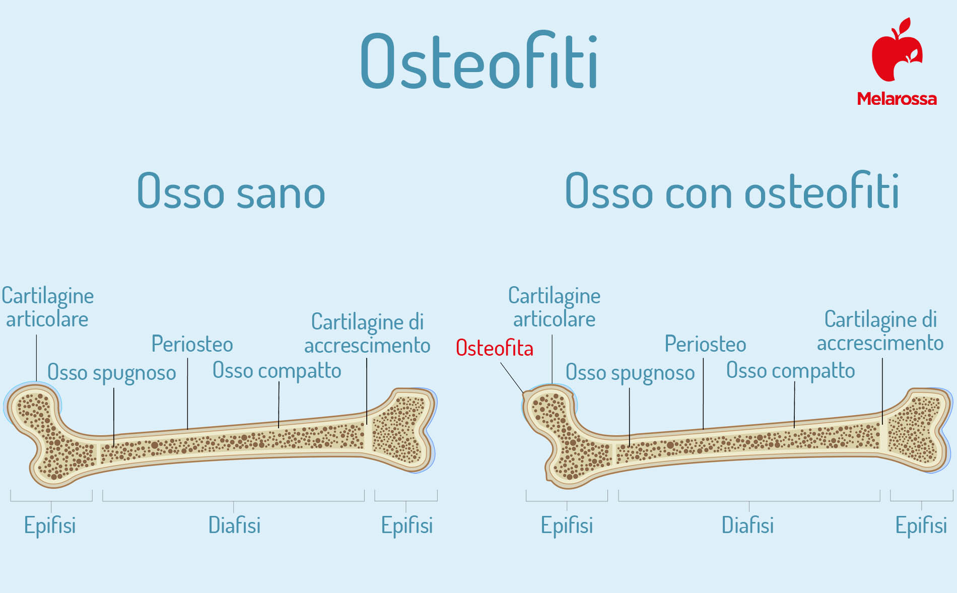 osteofitosi: formazione di osteofiti