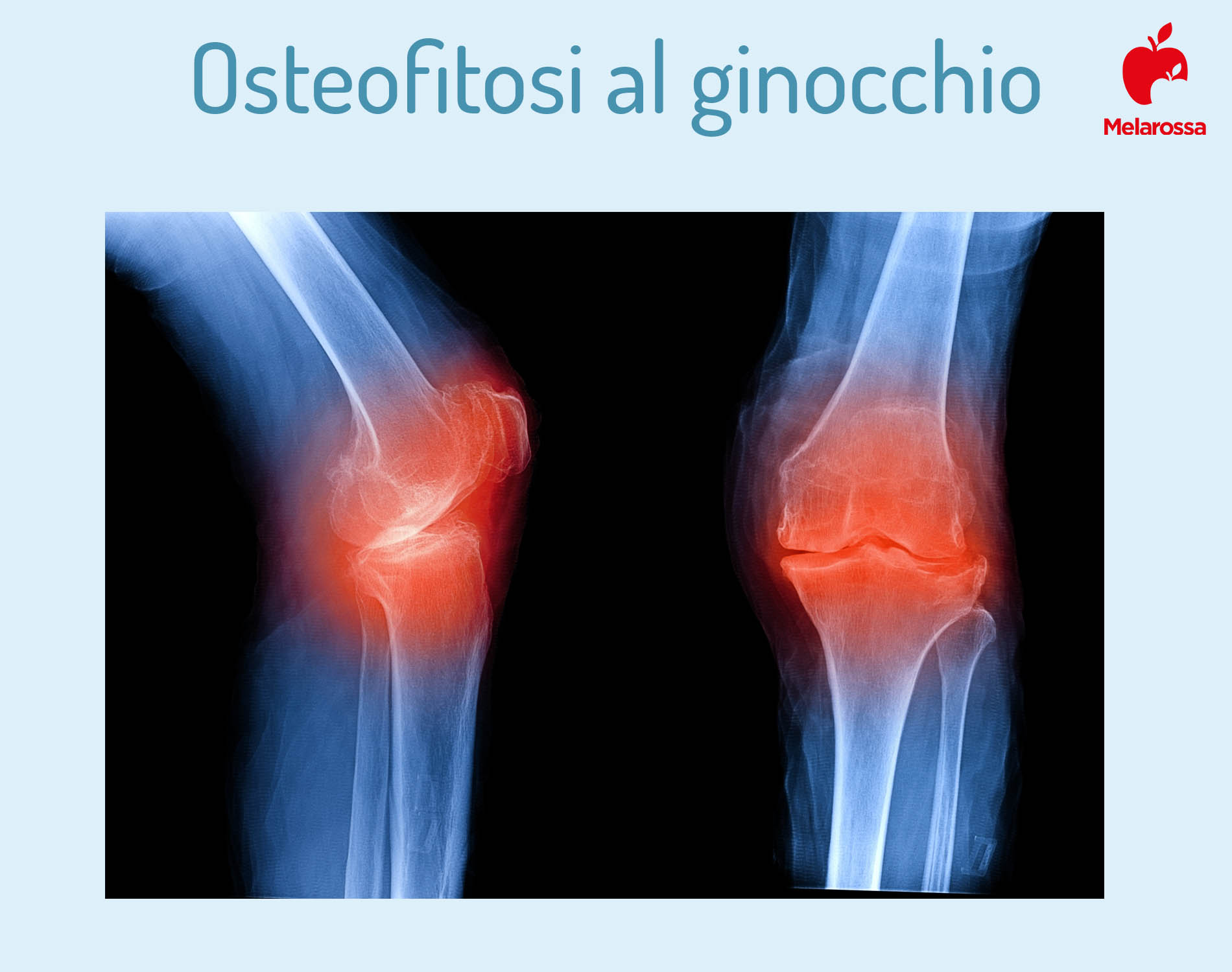 osteofitosi al ginocchio- Foto 