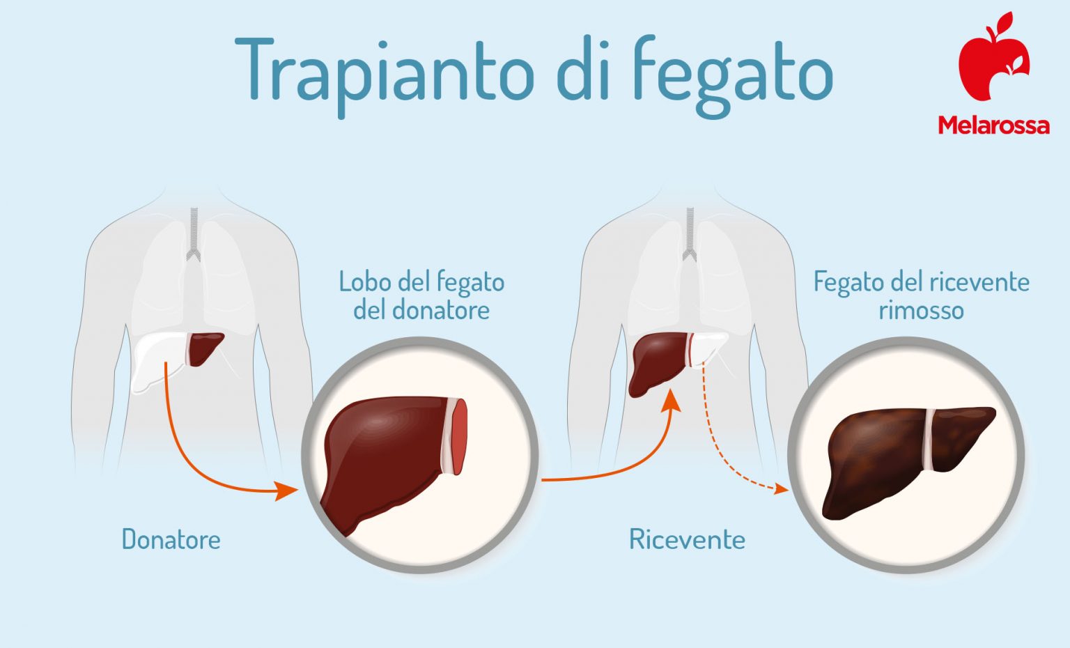 Trapianto di fegato cos'è, tipi, quando