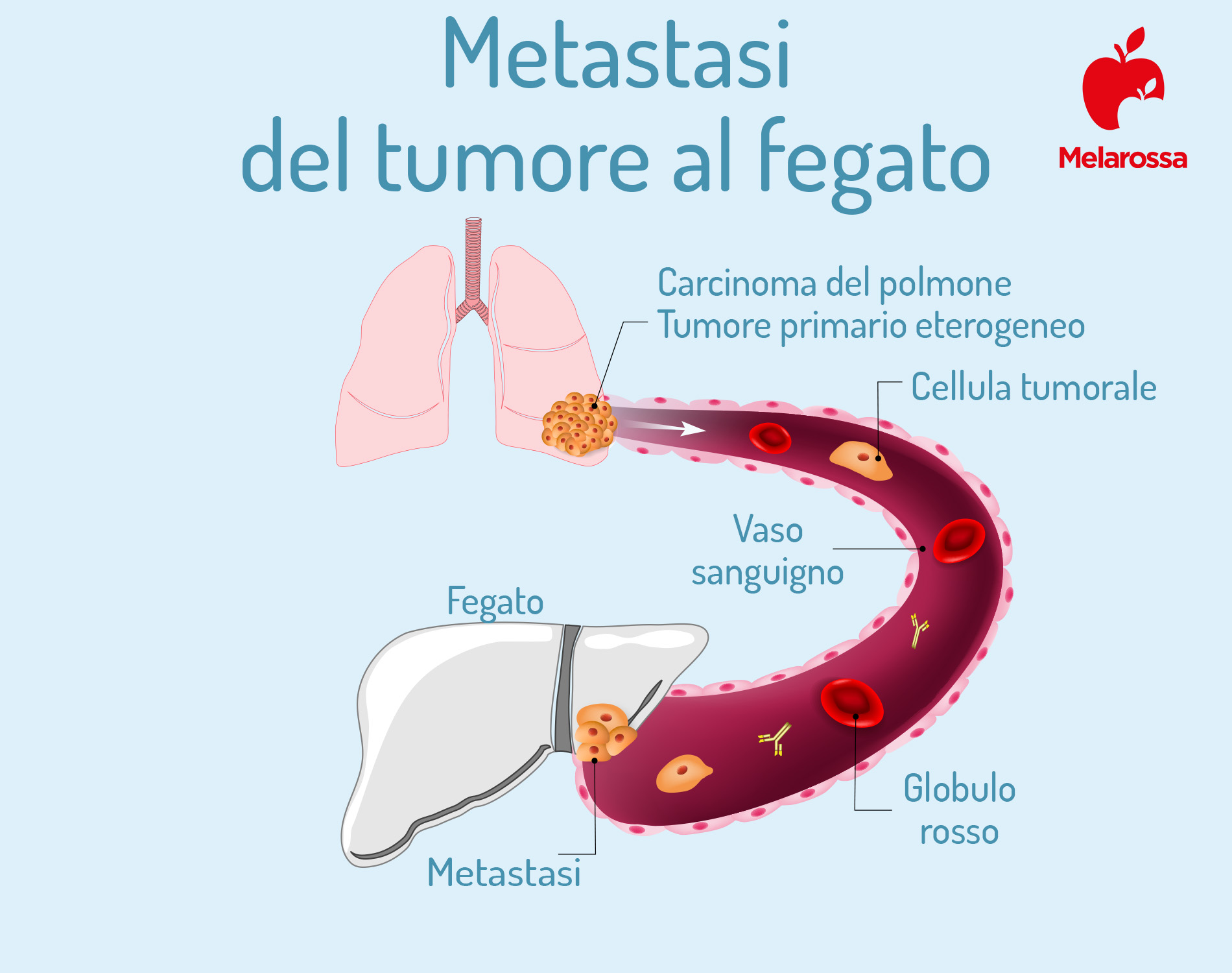 metastasi: tumore al fegato 