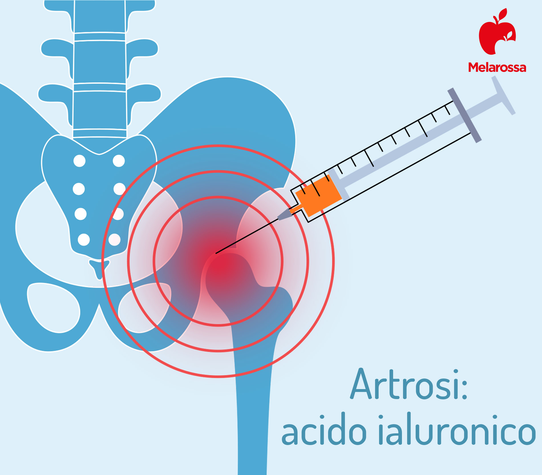 curare artrosi con acido ialuronico