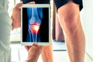 Artrosi: cos’è, sintomi, cause, diagnosi, come si cura, cosa mangiare e come convivere con la malattia
