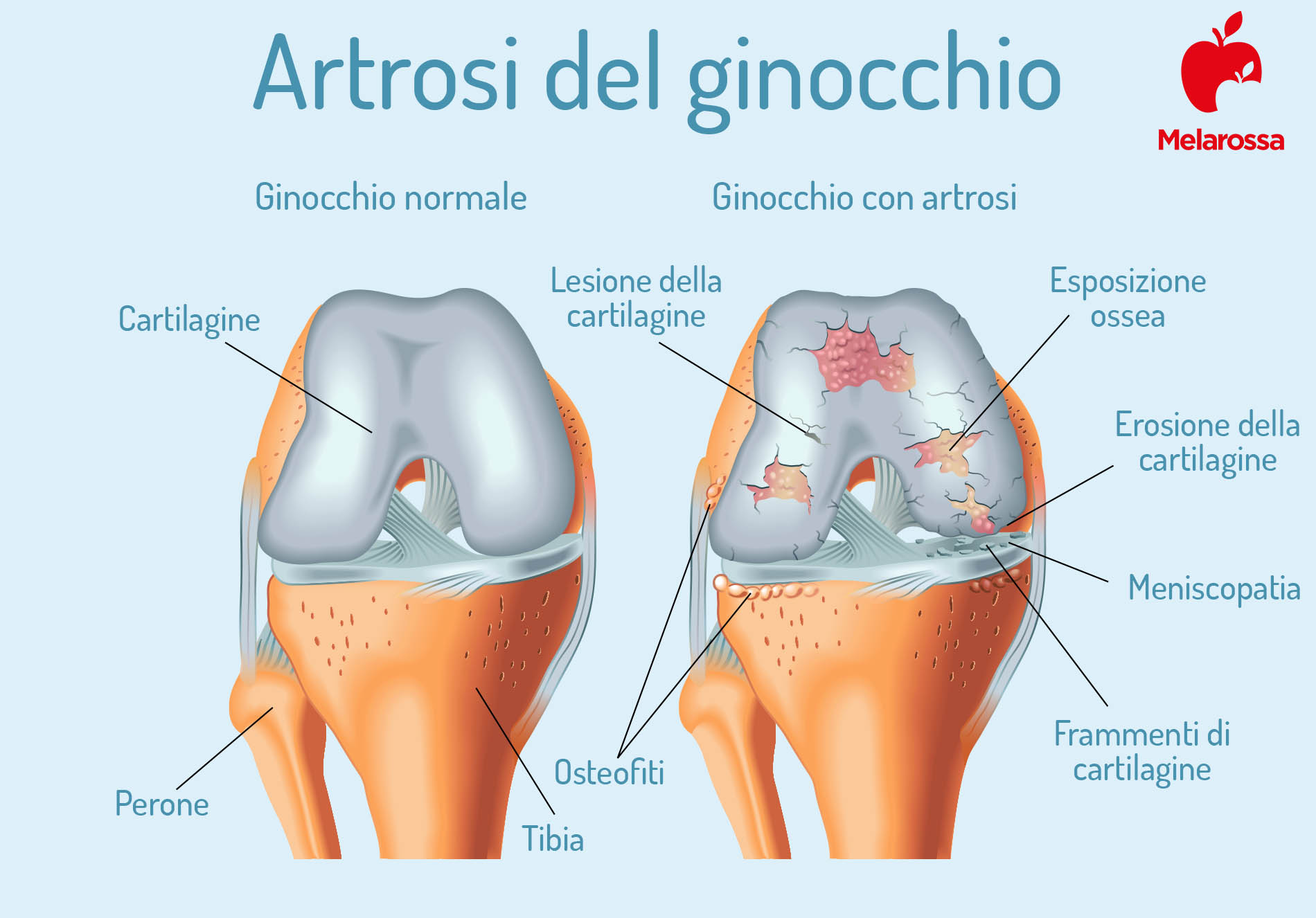 artrosi: ginocchio