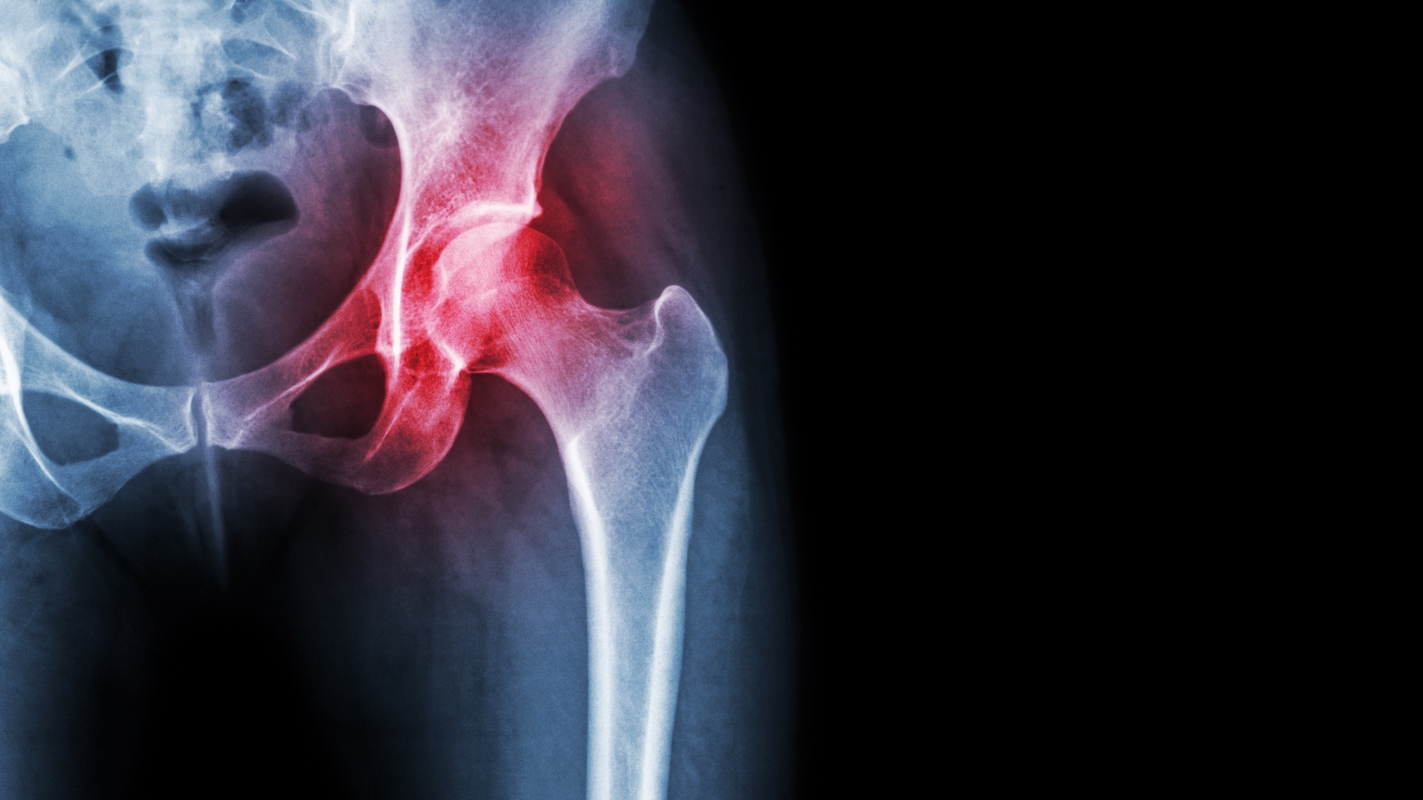 coxartrosi: diagnosi dell'artrosi dell'anca 