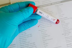 Epatite E: cos’è, come si trasmette, sintomi, cause e soggetti a rischio, cure e trattamenti, possibili complicazioni
