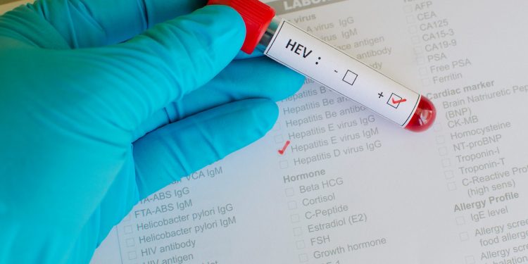 epatite E : cos'è, cause, sintomi, diagnosi, cure e dieta