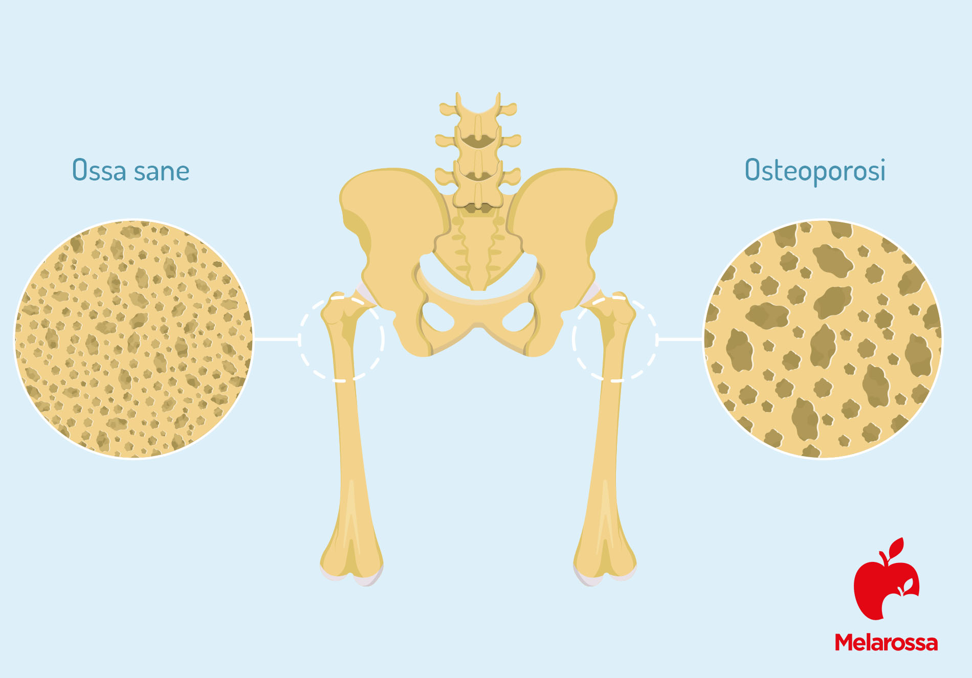 osteoporosi: ossa