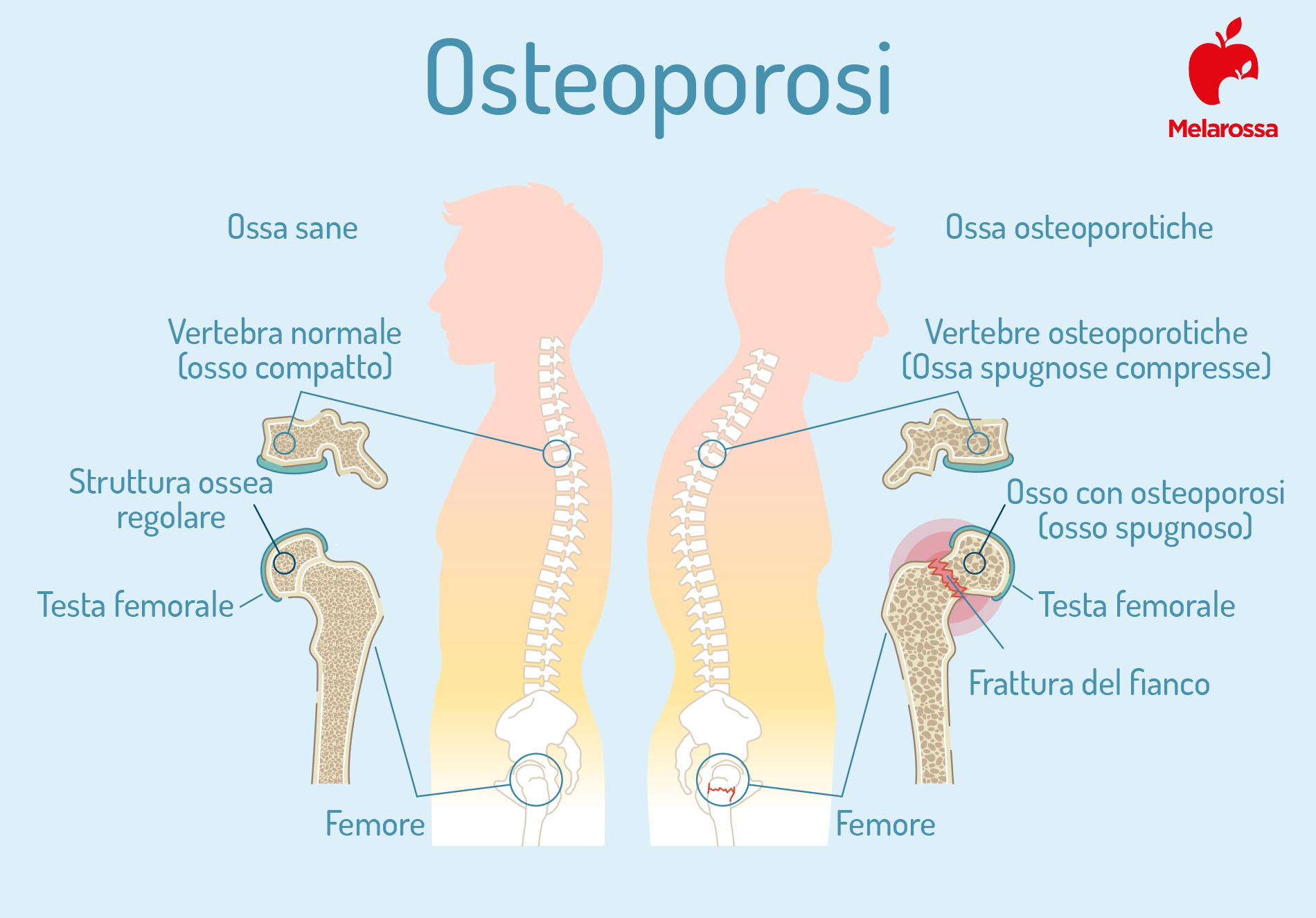 osteoporosi: sintomi