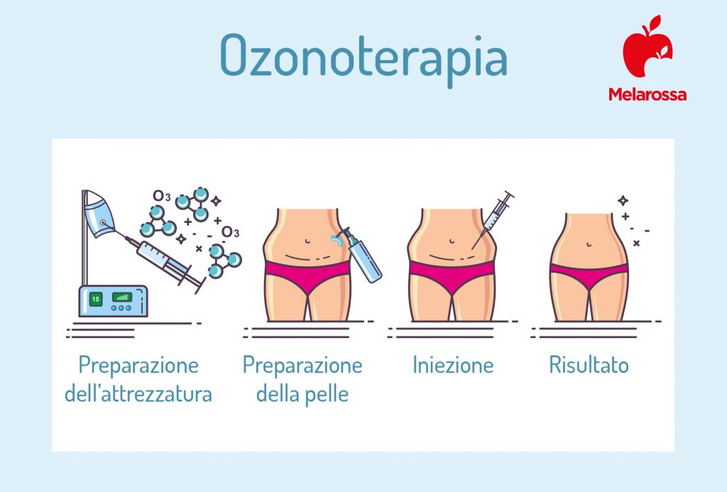 Ozonoterapia cos'è, a cosa serve, benefici e controindicazioni Ozonoterapia cos'è, a cosa serve, benefici e controindicazioni