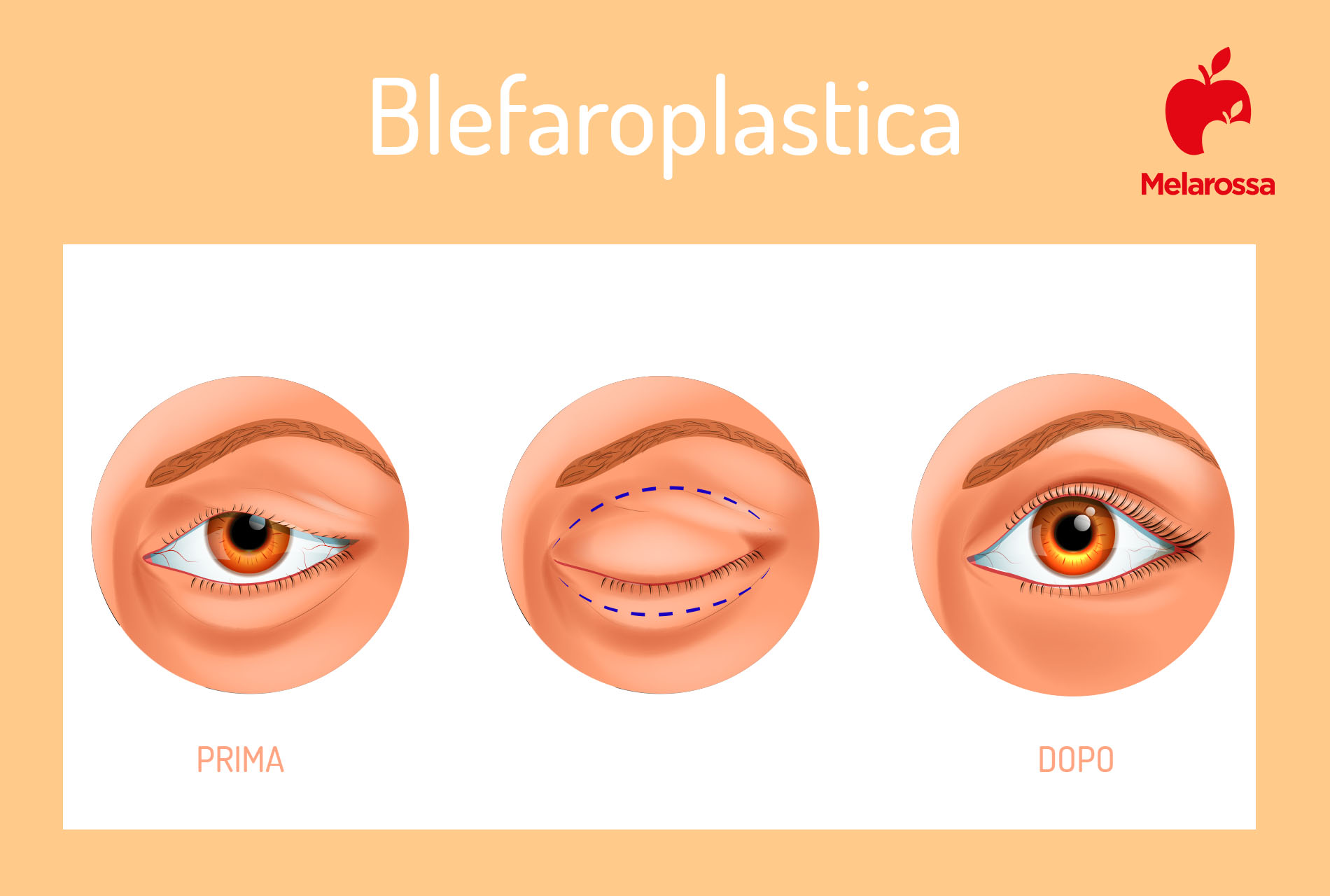 blefaroplastica: prima e dopo