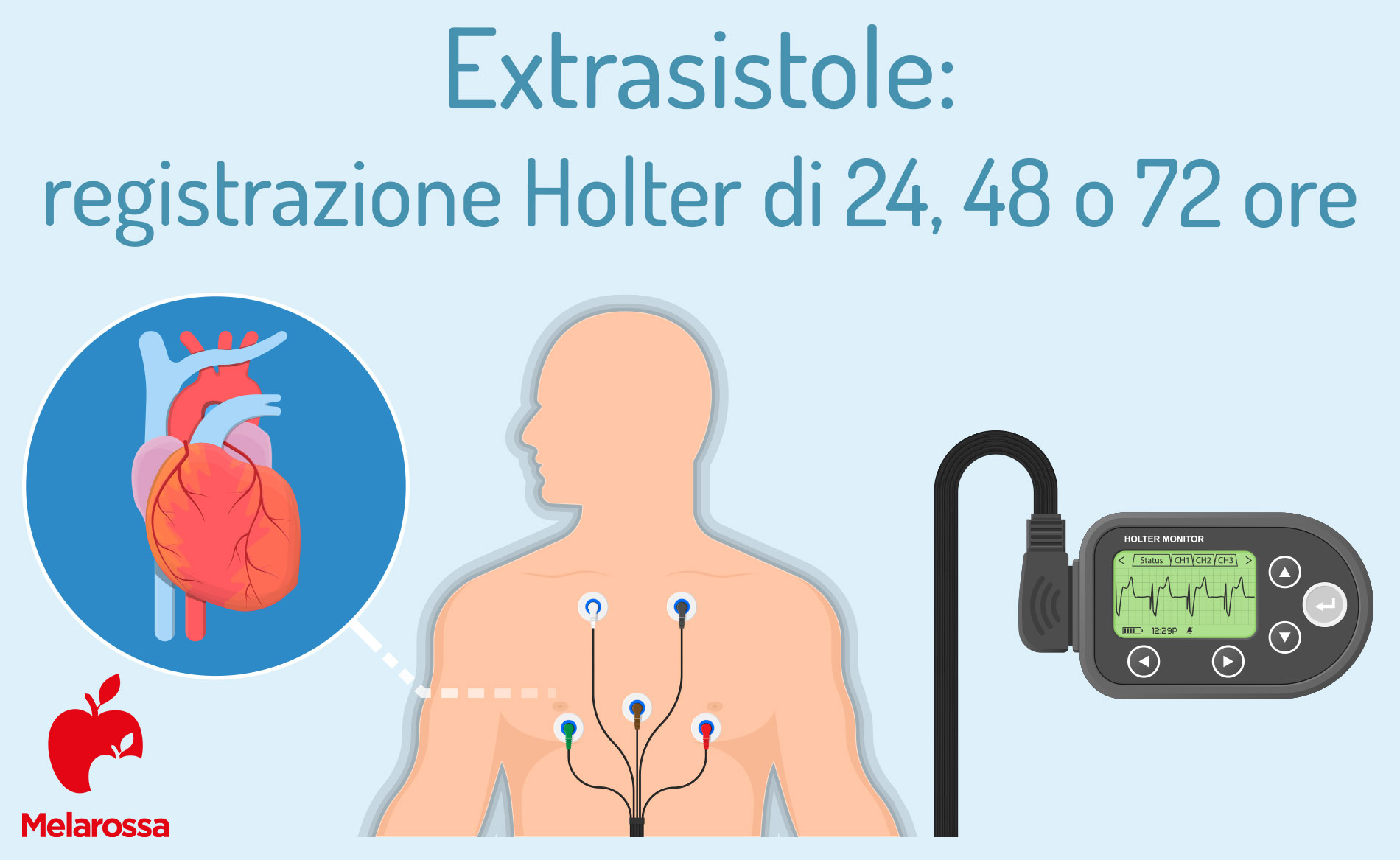 extrasistole: diagnosi con Holter di 24, 48 o 72 ore