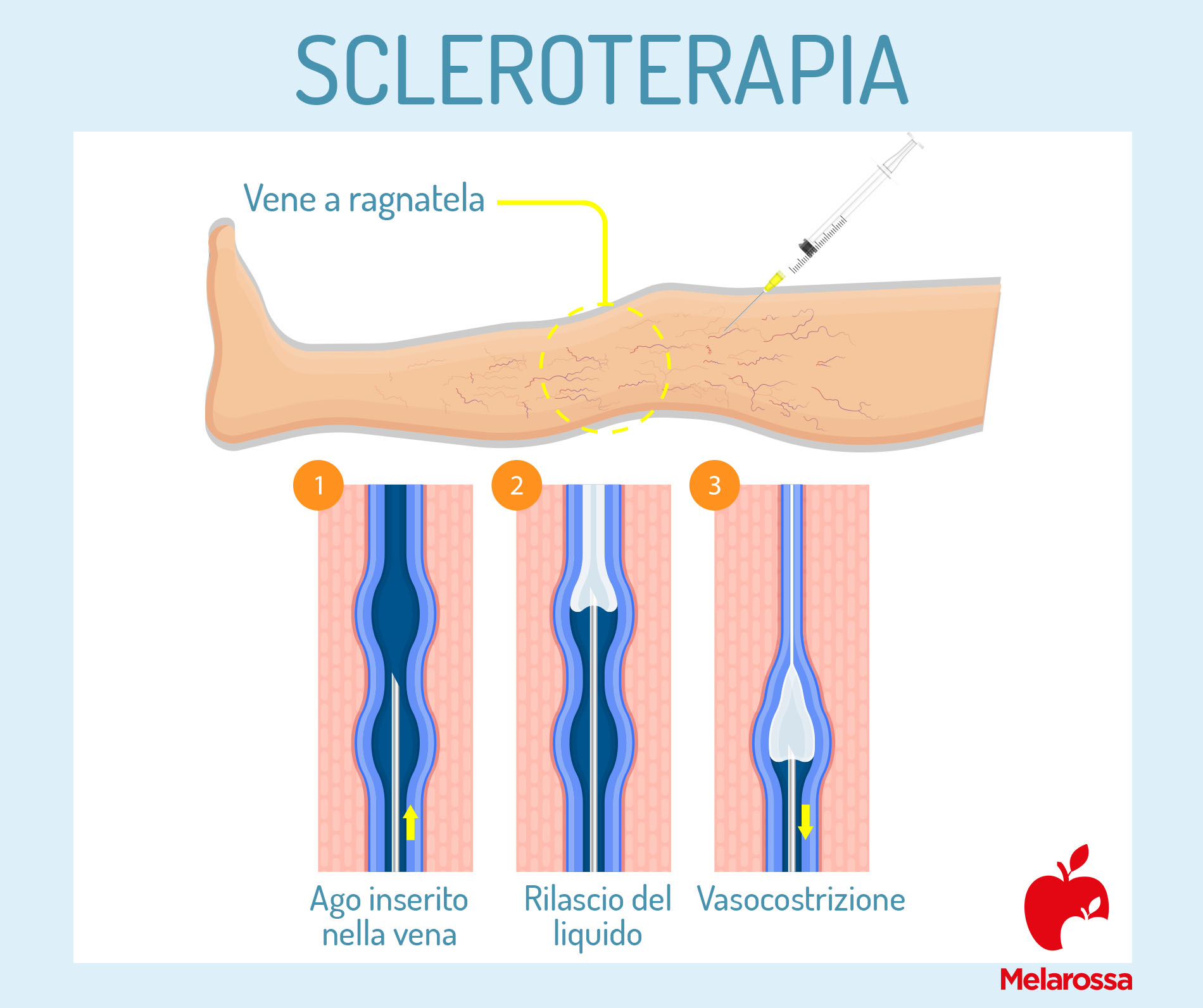 vene varicose: scleroterapia