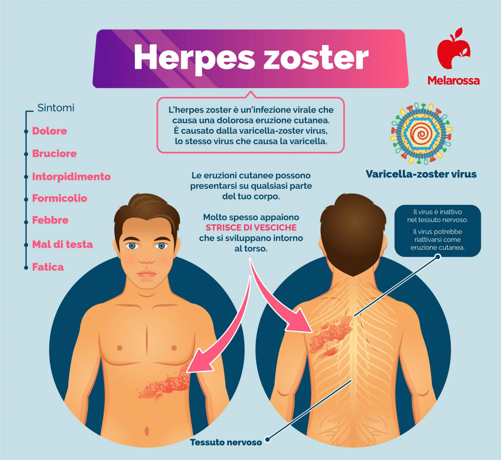 herpes zoster: sintomi