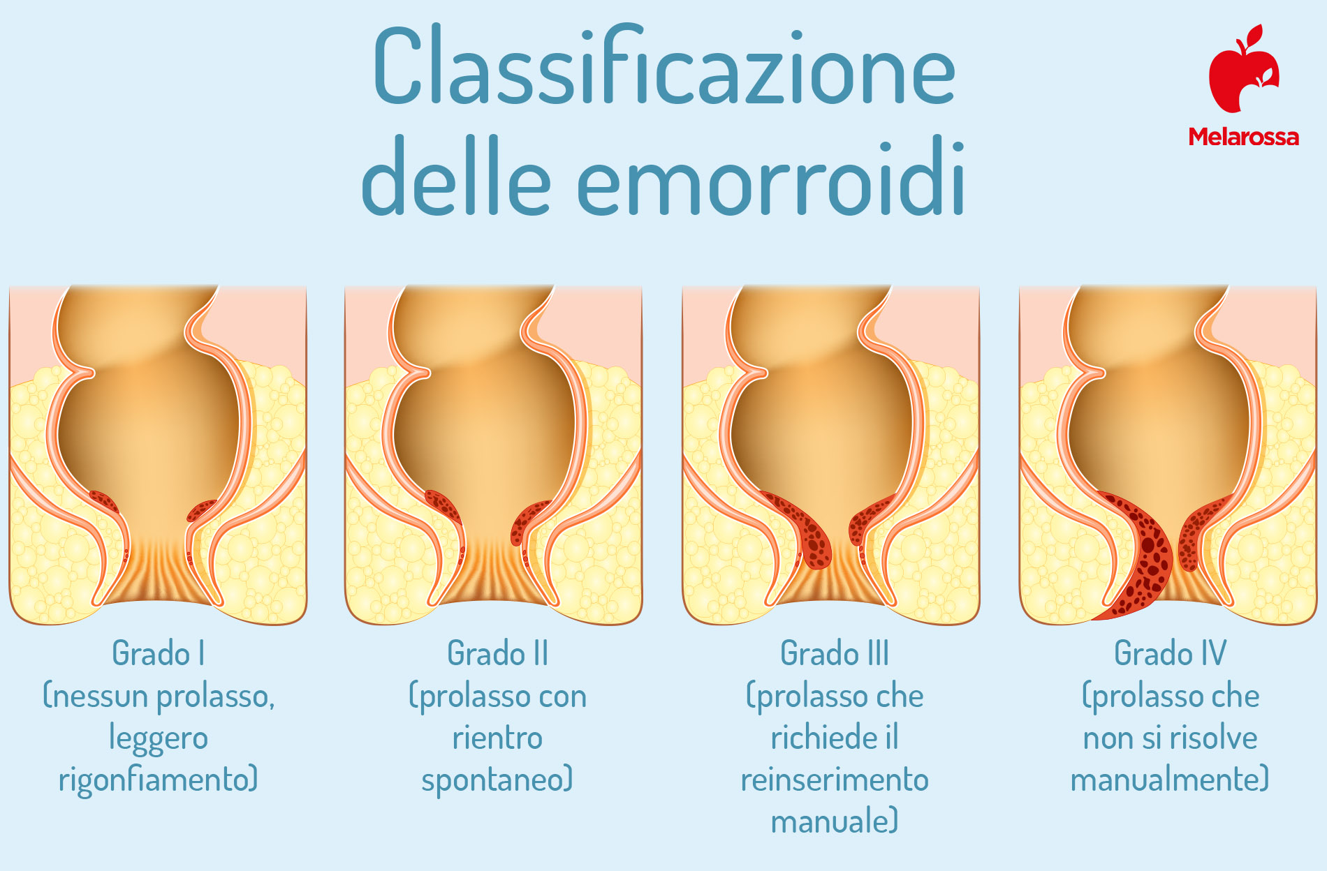 Emorroidi Cosa Sono Cause E Sintomi Cosa Mangiare Rimedi The Best