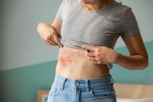 Herpes zoster o fuoco di Sant’Antonio: cura, cause, sintomi e cibi da evitare
