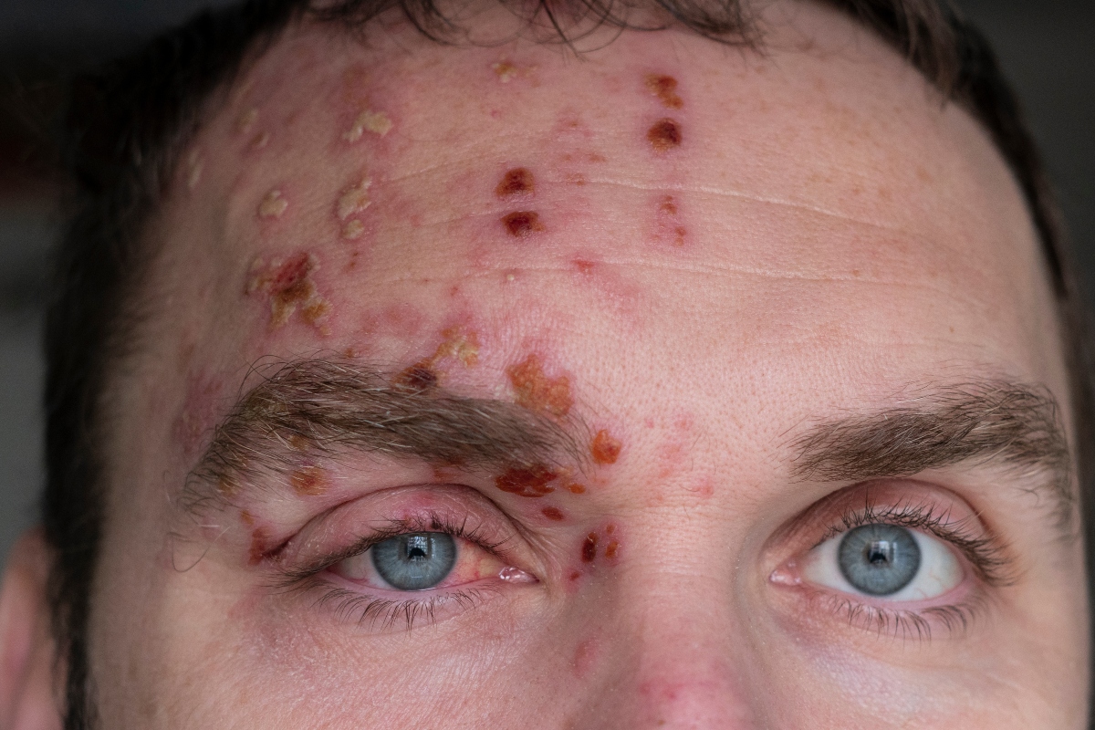 herpes zoster oftalmico: foto