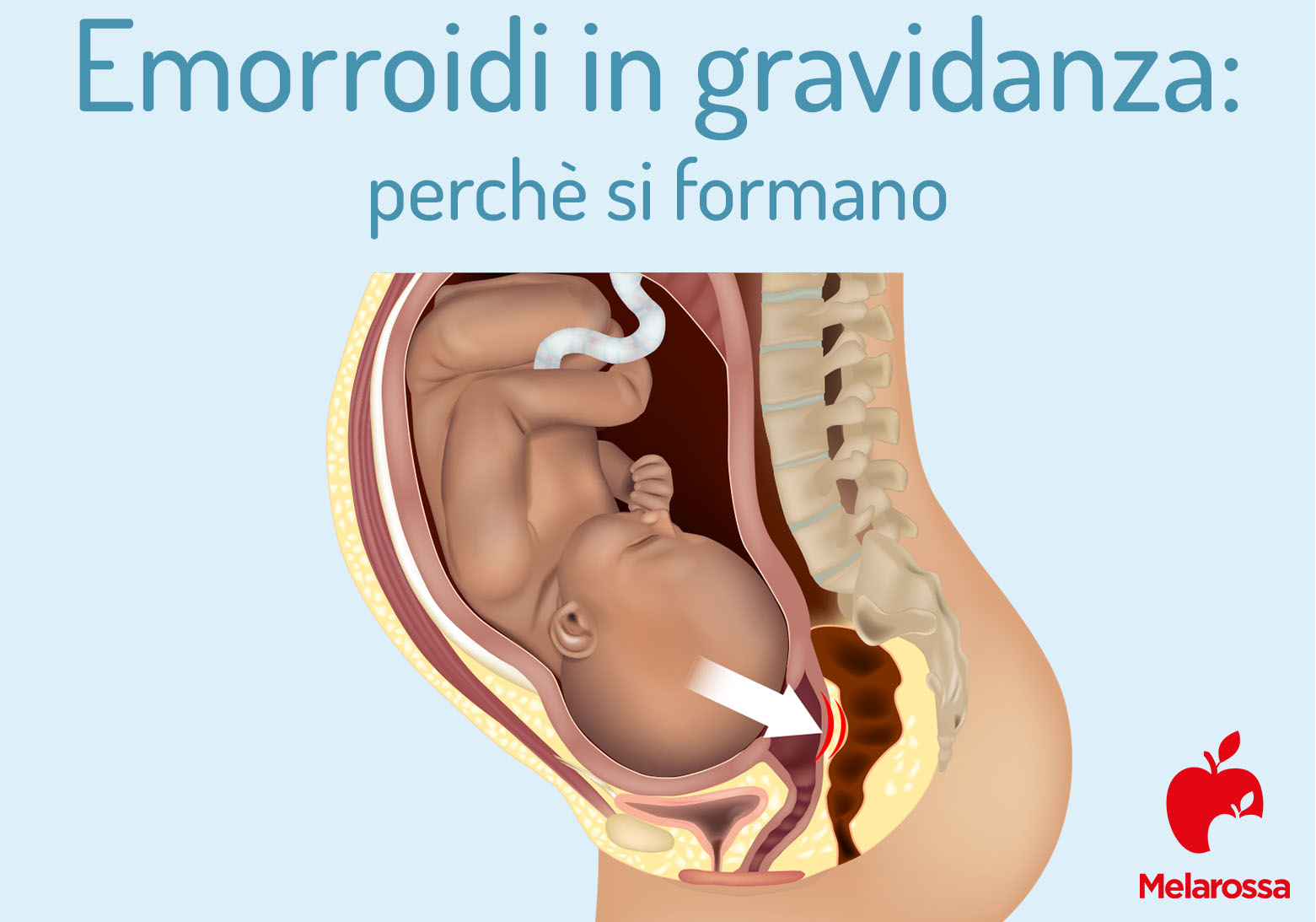 emorroidi in gravidanza: perché si formano 
