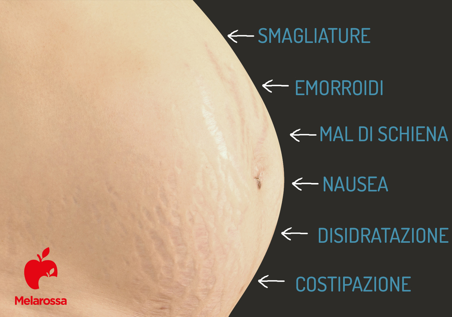 emorroidi in gravidanza: sintomi 
