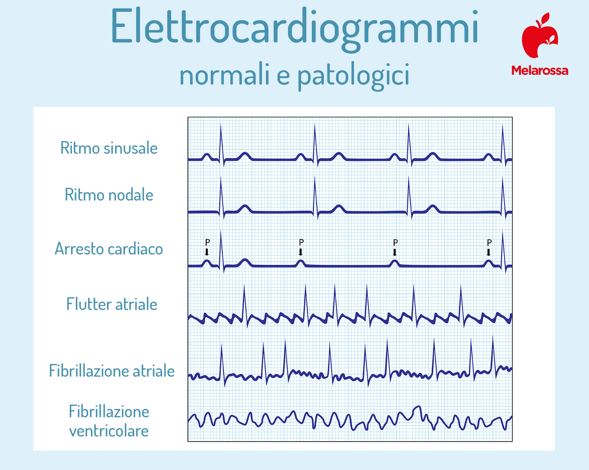 elettrocardiogramma: risultati normali e patologici