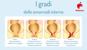 Pomata Per Le Emorroidi: Quale Scegliere? Come Si Usa - Foto 9