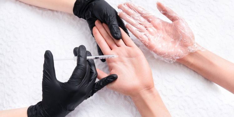 Un medico che sta eseguendo un'iniezione nelle mani di una donna che soffre di iperidrosi
