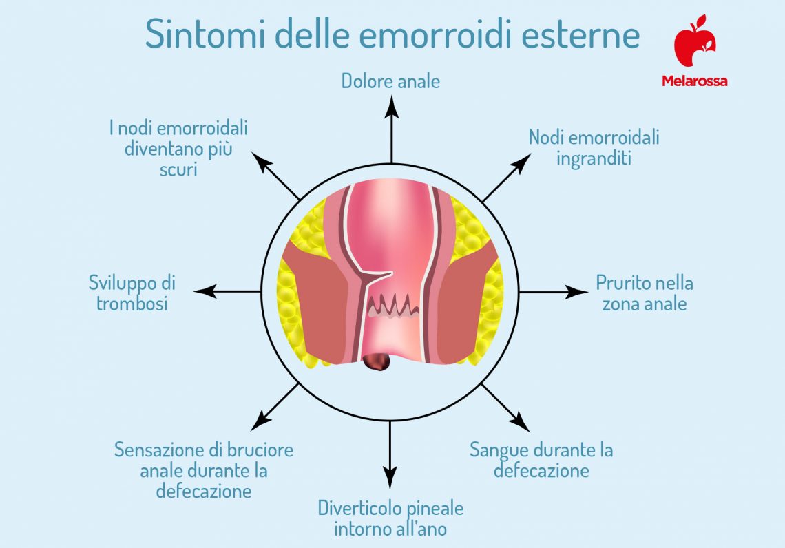 Emorroidi Esterne E Interne Cause Sintomi E Rimedi Fn Project Hot Sex