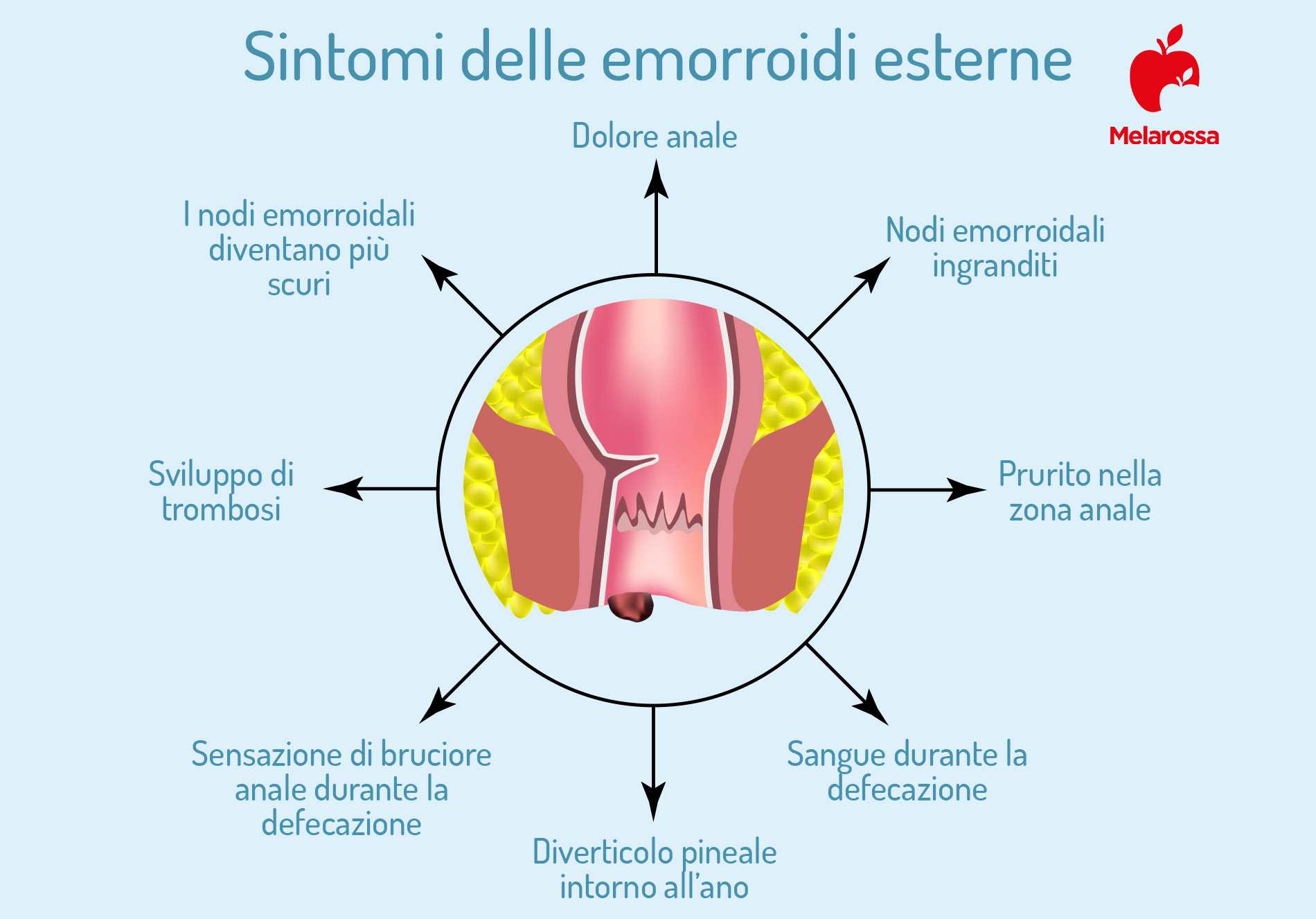 emorroidi esterne: sintomi
