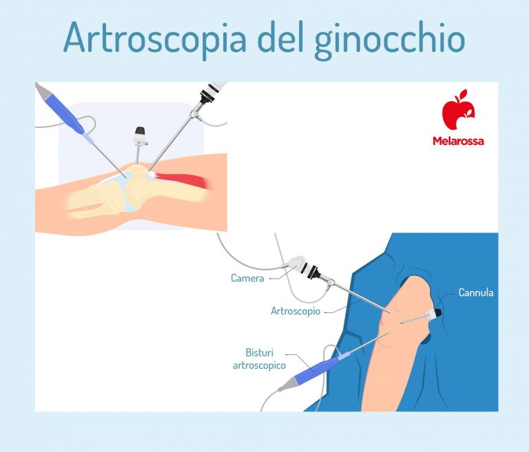 Menisco: anatomia, sintomi e cure della rottura e della lesione