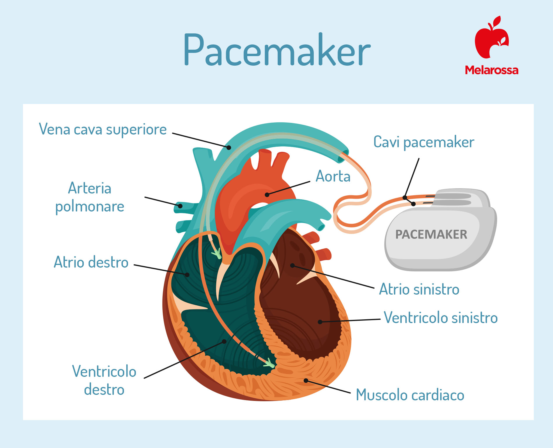 bradicardia: pacemaker