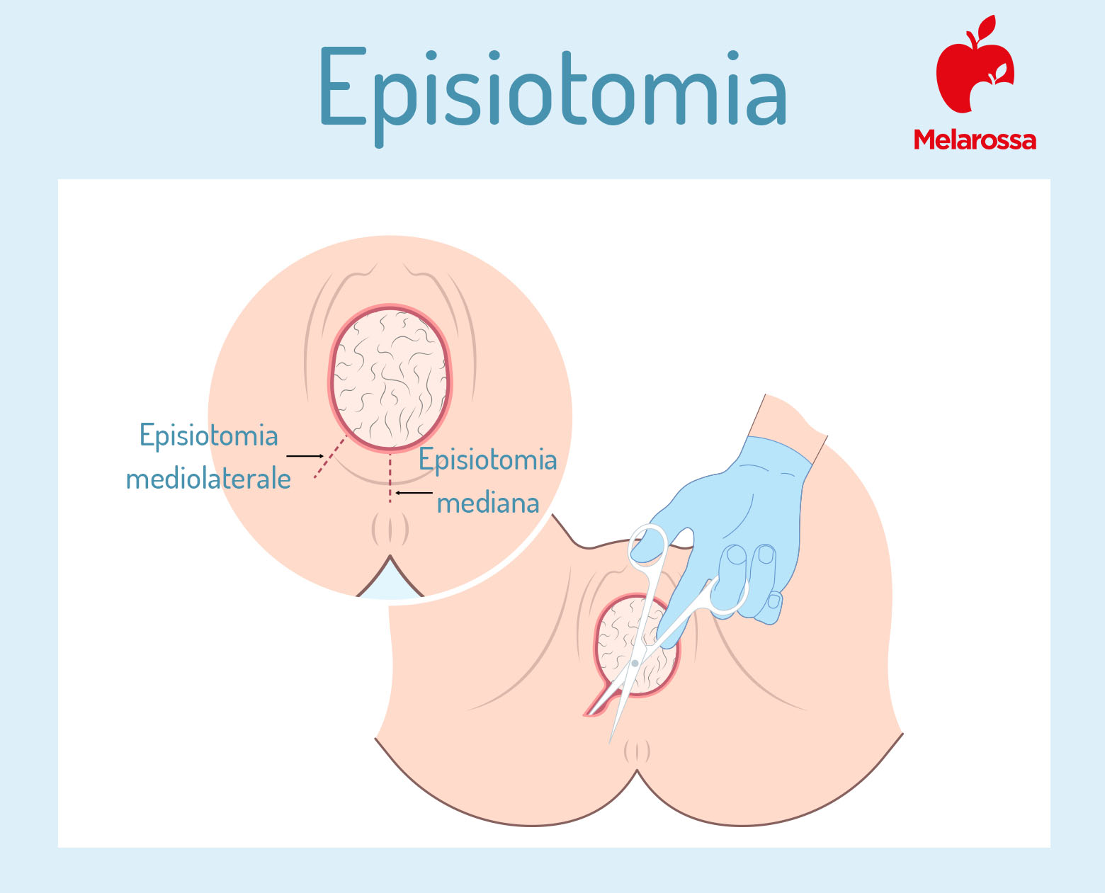 episiotomia: che cos'è
