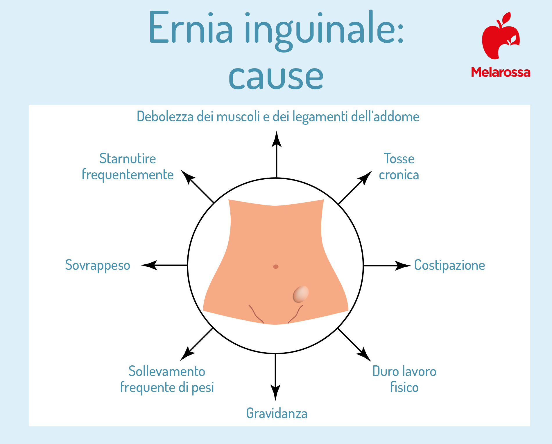 ernia inguinale: cause