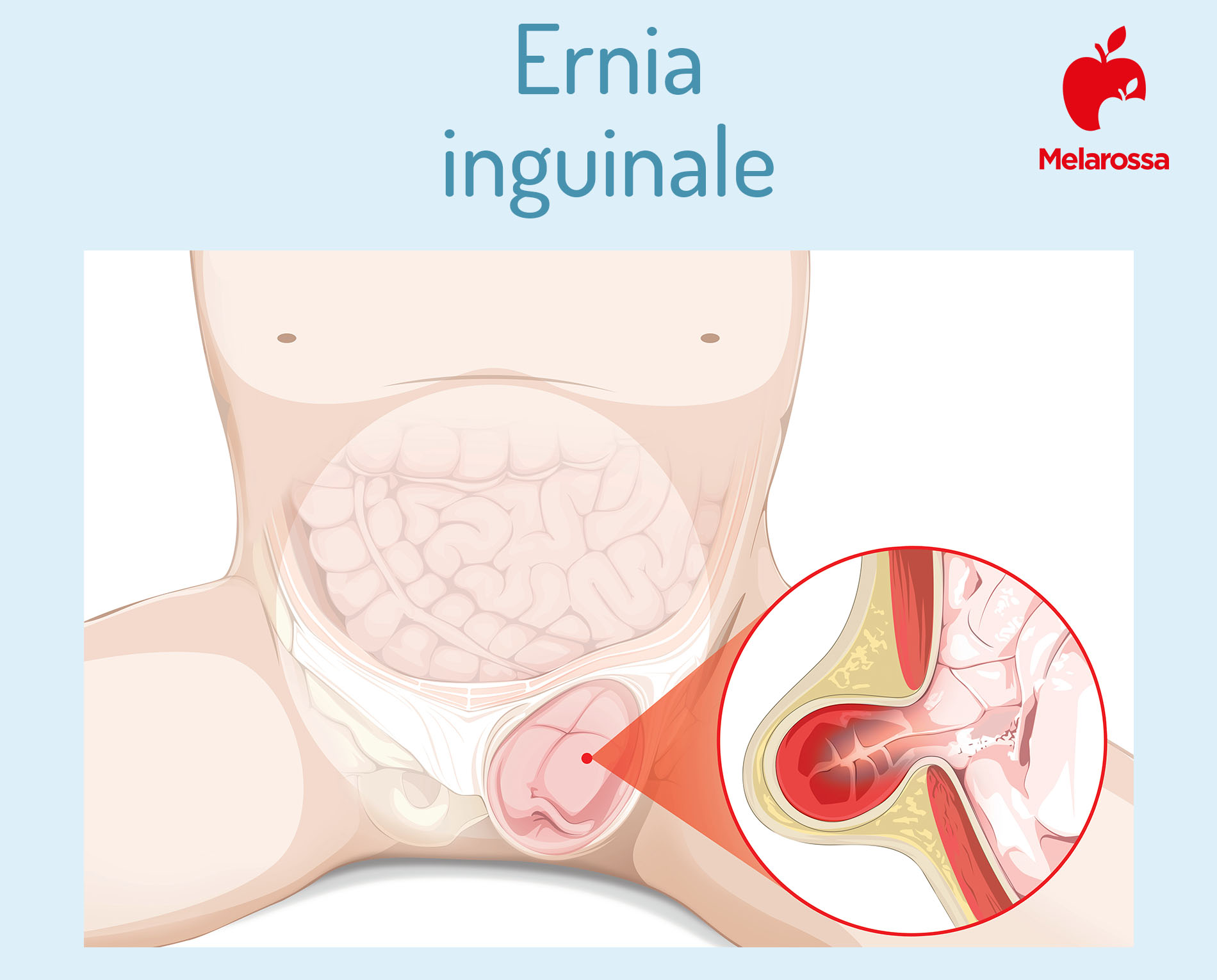 L'ernia inguinale nell'uomo, interpretare i sintomi, prevenirla e