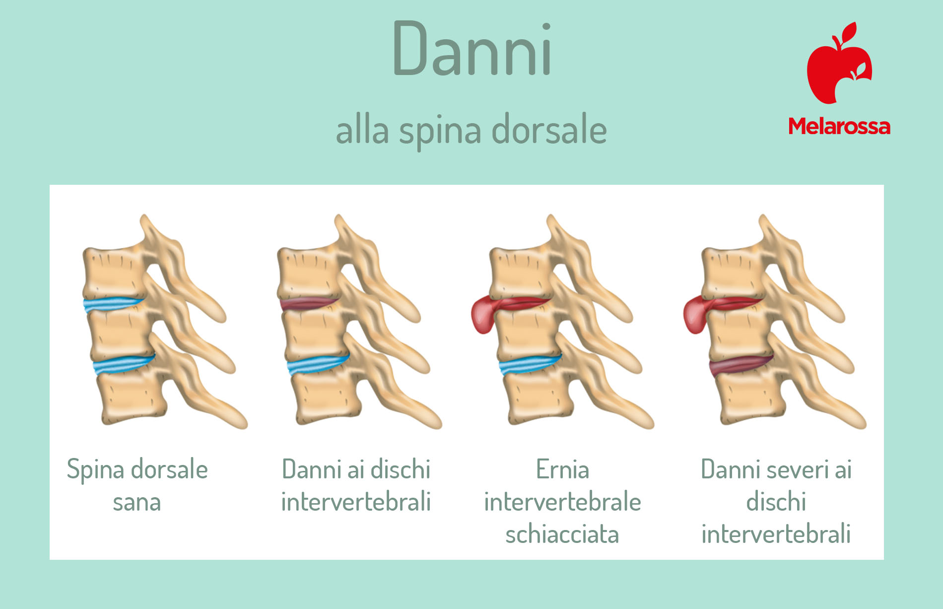 lombalgia: danni alla spina dorsale 