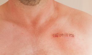 Pacemaker: che cos’è, come funziona, tipi, come si impianta, benefici, controindicazioni