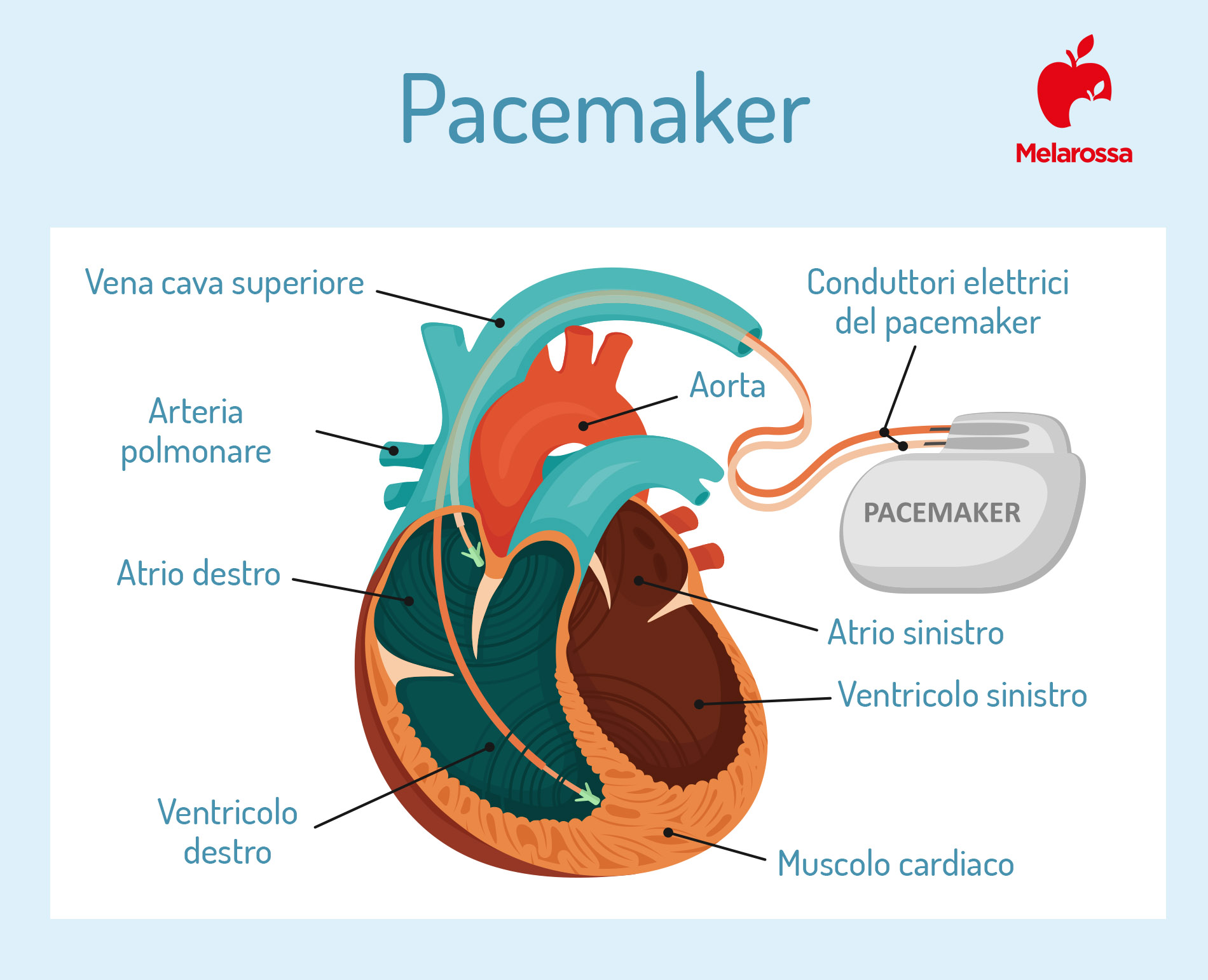 pacemaker: come si impianta