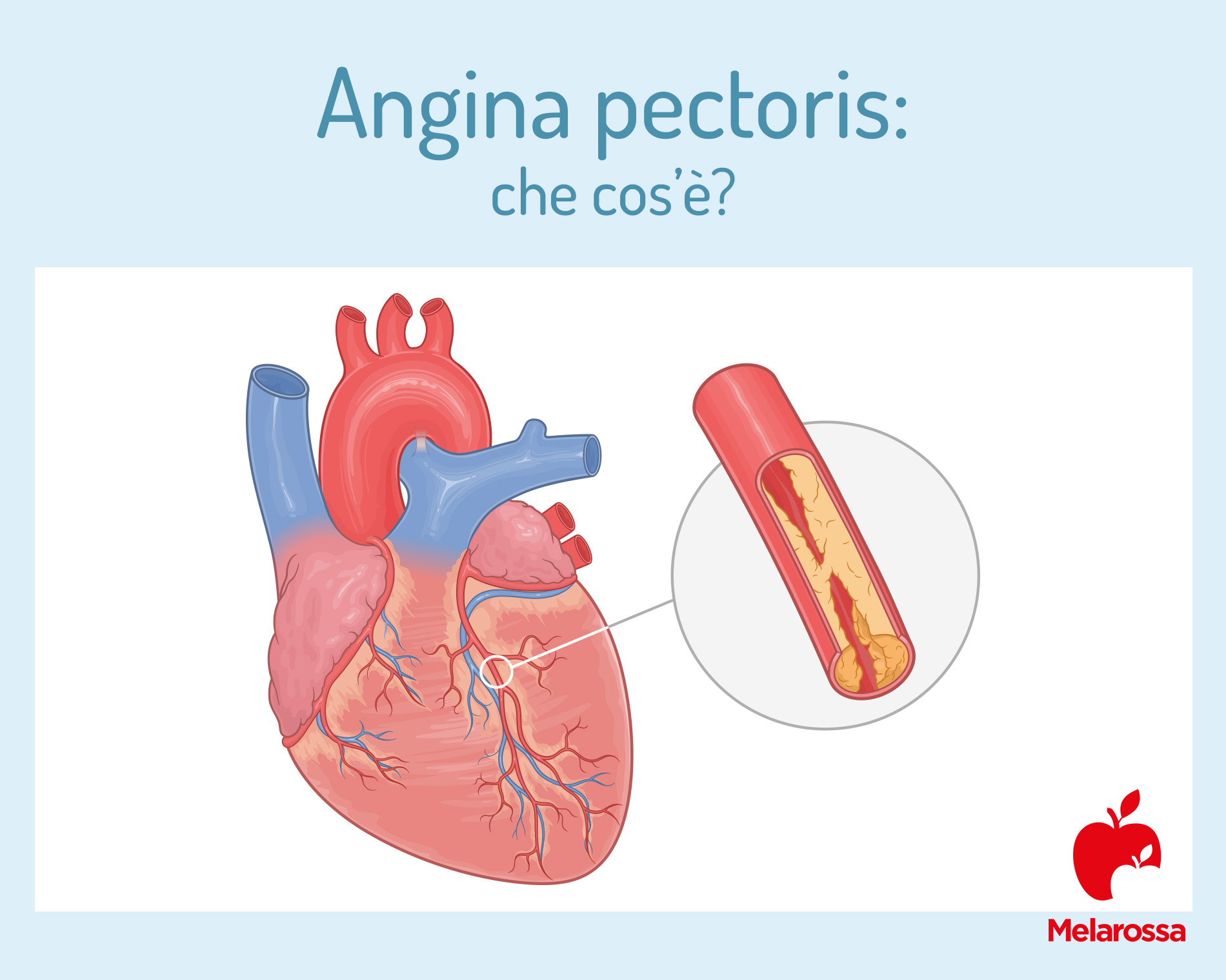 angina pectoris: che cos'è