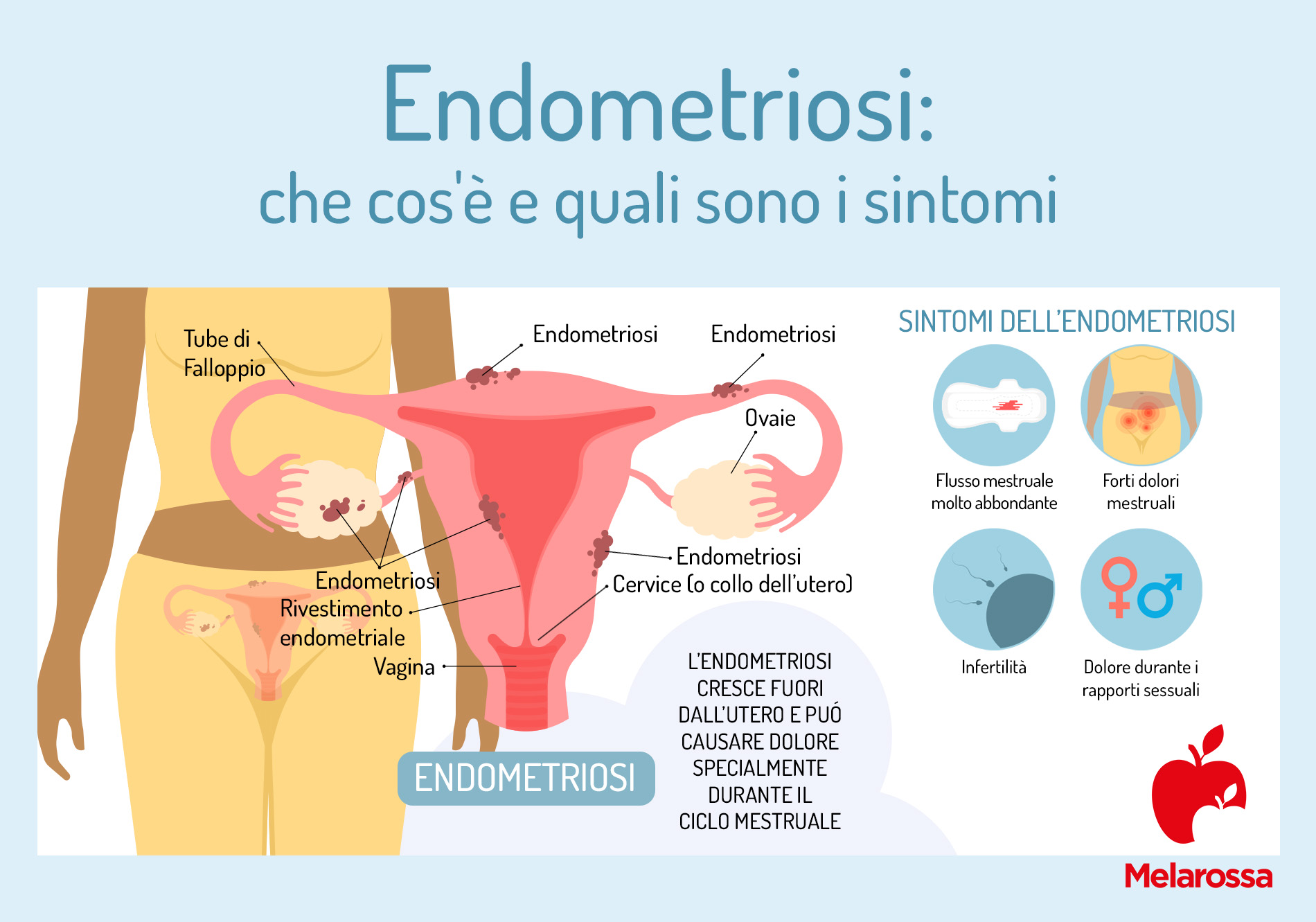 endometriosi: che cos'è e quali sono i sintomi