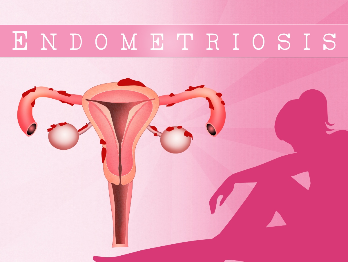 endometriosi: quali sono i sintomi 