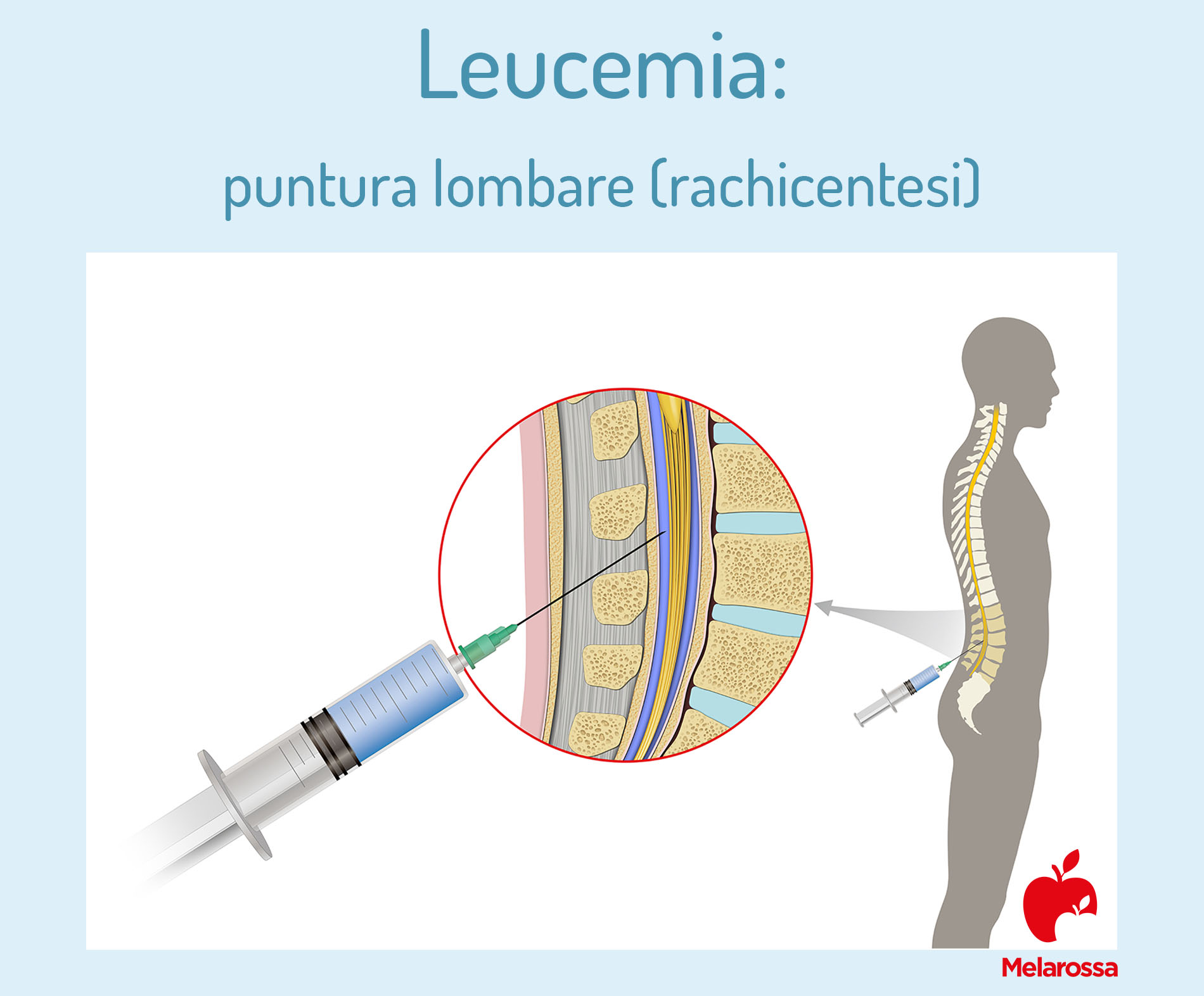 leucemia e puntura lombare 