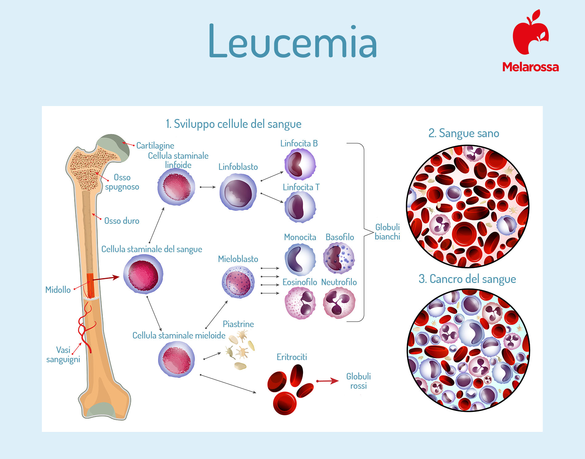 leucemia: sviluppo cellule nel sangue