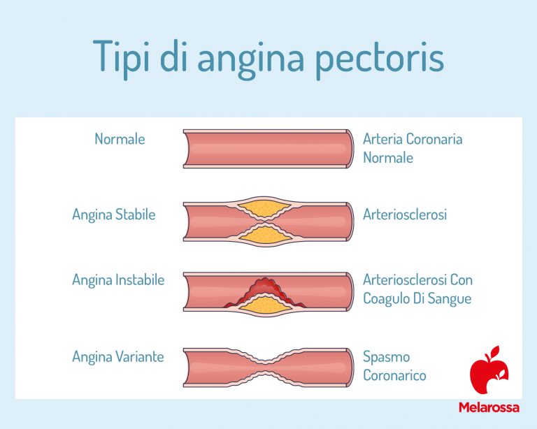 38+ Angina Teich, La crise douloureuse d&#039;angine de poitrine cède