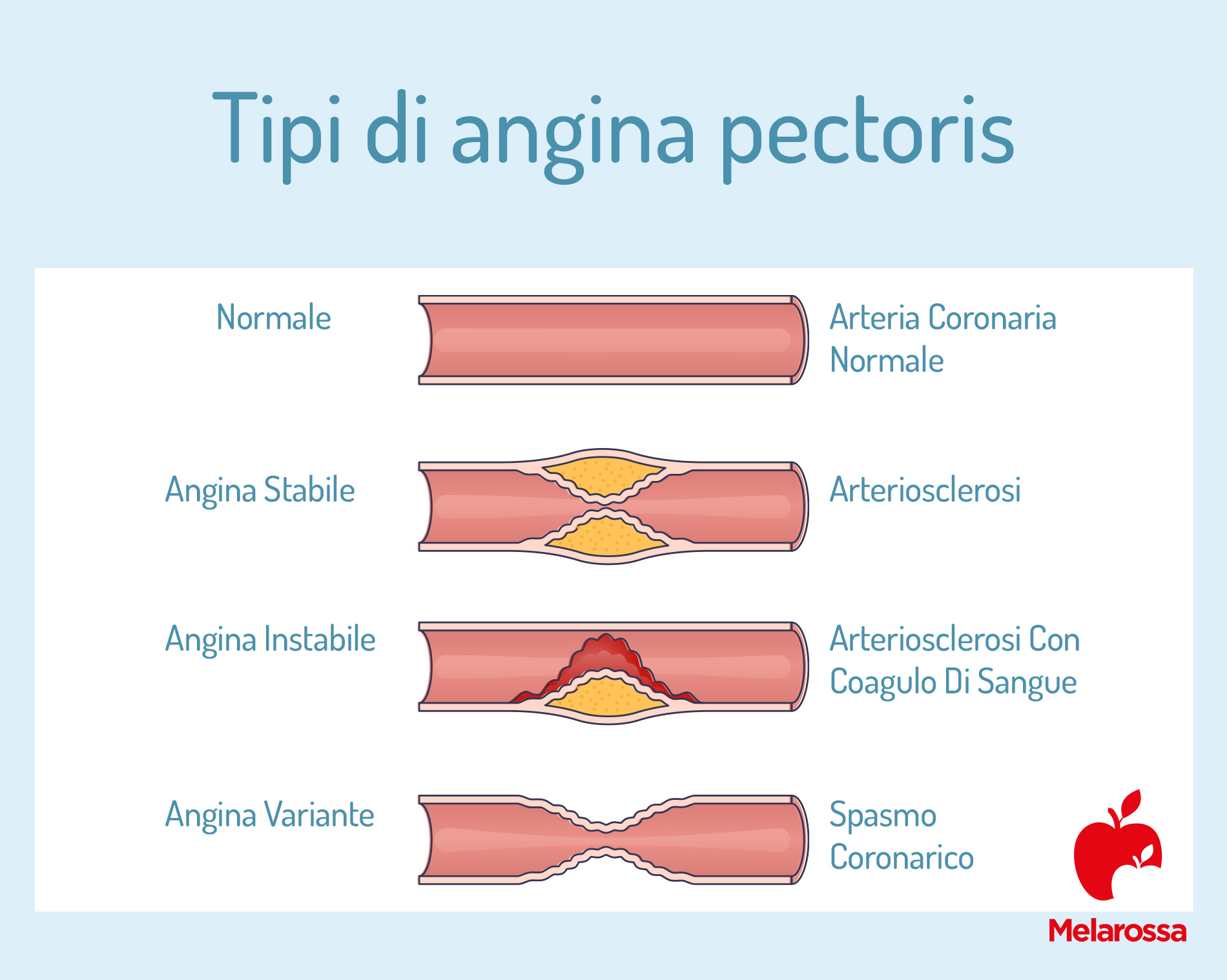 tipi di angina pectoris