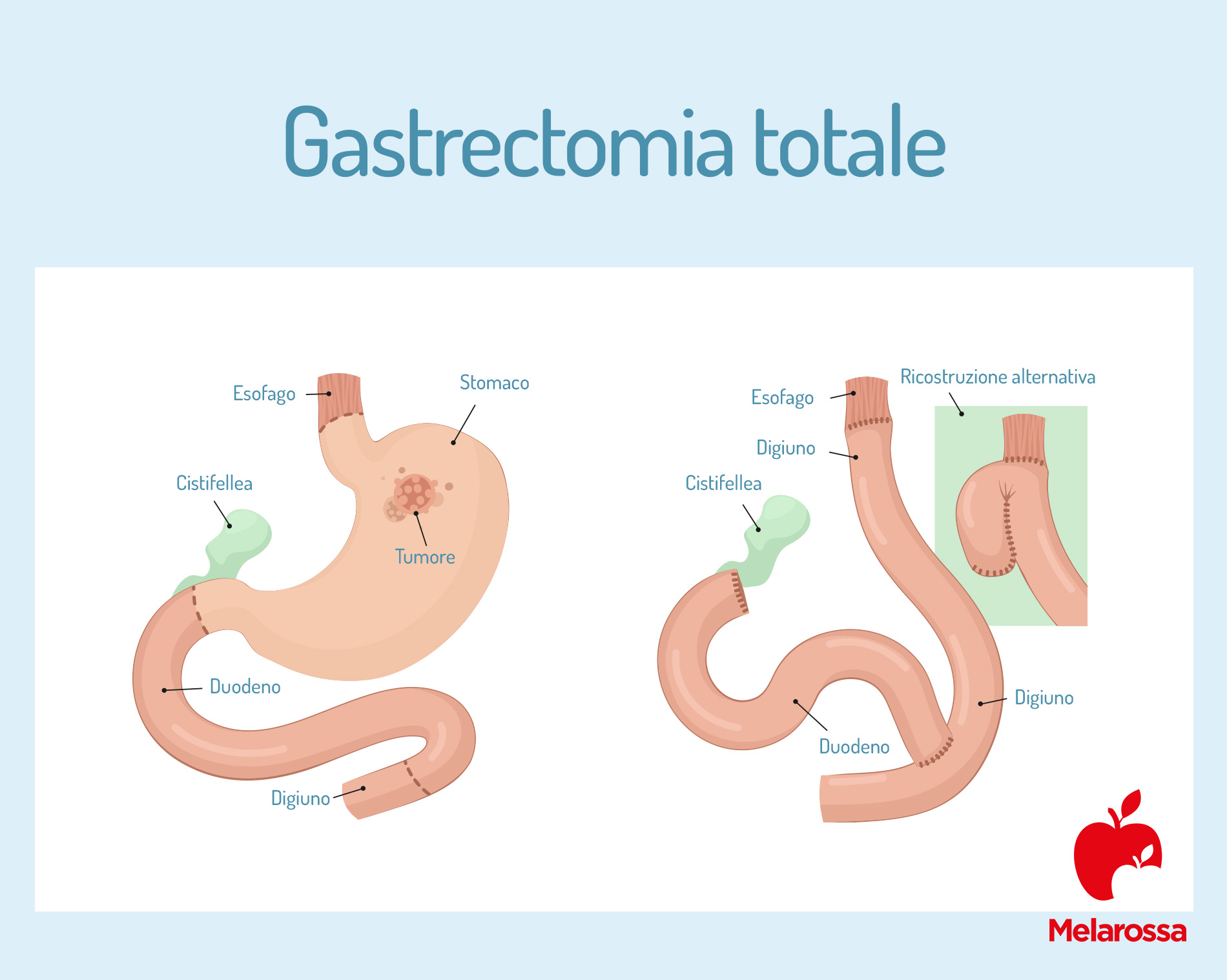 tumore allo stomaco: gastrectomia 