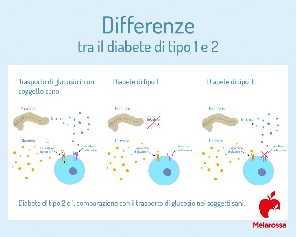 Diabete di tipo 1 che cos'è, cause, sintomi, diagnosi e cure