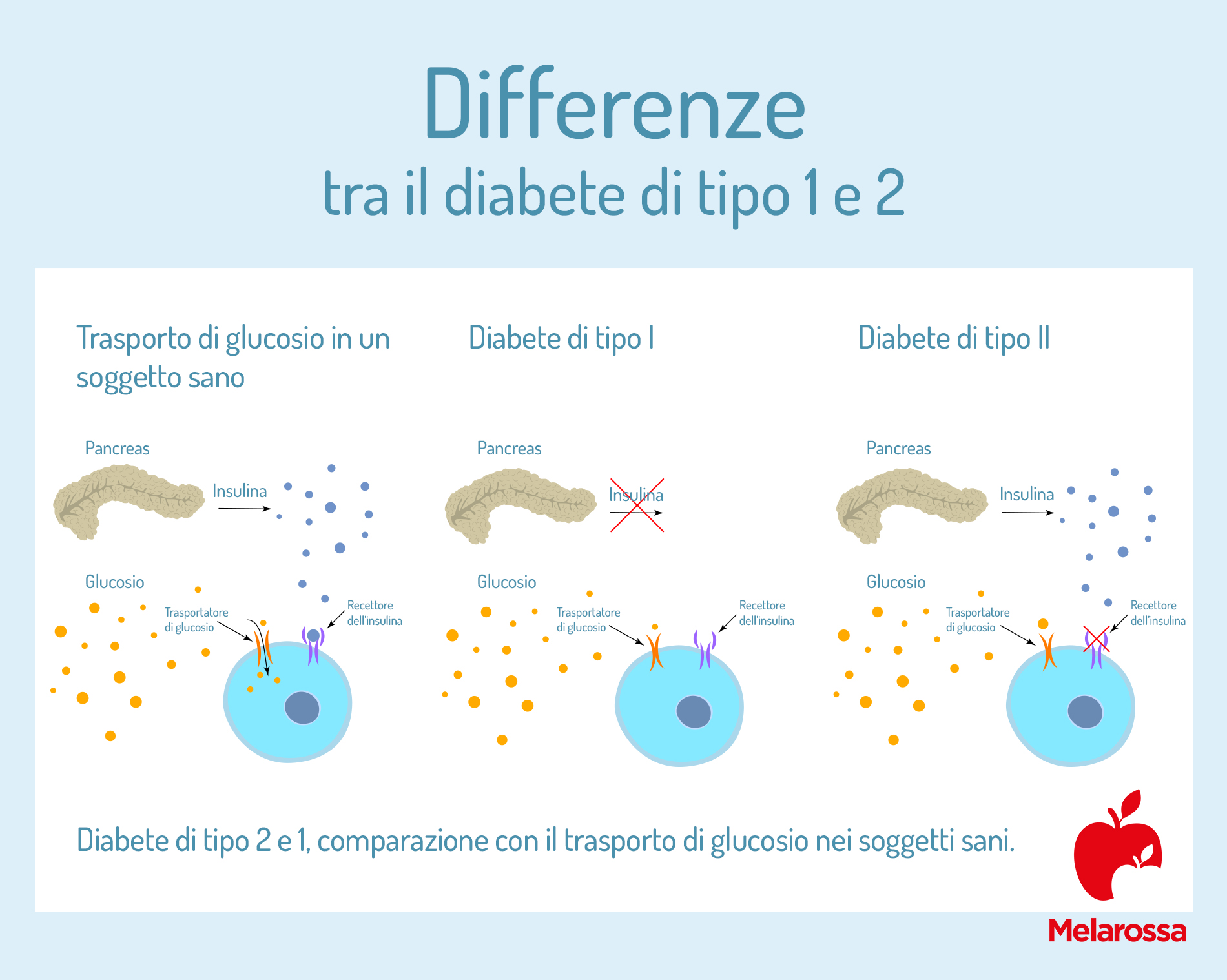 differenze tra il diabete di tipo 1 e di tipo 2