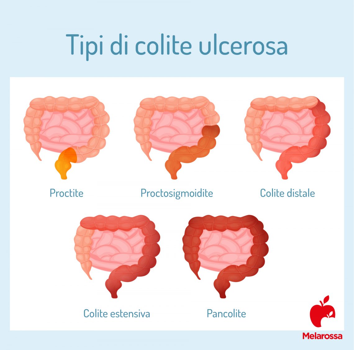 Colite ulcerosa che cos'è, sintomi, cause, cure e cosa mangiare Colite ulcerosa che cos'è, sintomi, cause, cure e cosa mangiare