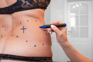 Liposuzione: cos’è, come funziona, benefici, costi e rischi