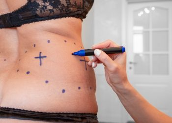 donna in mutande e reggisono di schiena che si fa disegnare dal chirurgo le zone che andrà a perdere durante la liposuzione